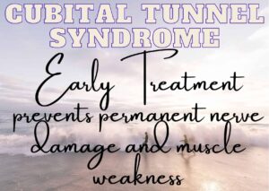 Cubital Tunnel Syndrome