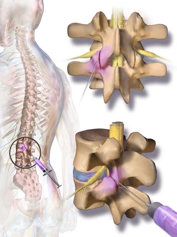 Endoscopic Spinal Surgery Illustration